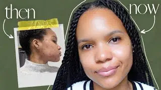 My Acne Journey | Hormonal cystic acne, Accutane, clearing my skin + favorite products