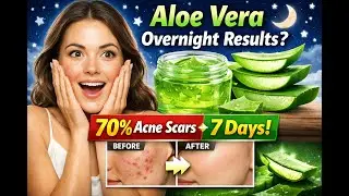 Overnight Aloe Vera Gel Removes Acne Scars? 70% Results in 7 Days!