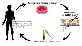 Sickle Cell Hope: Exa-cel - The CRISPR Therapy Making a Difference