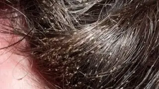 #LiceRemoval #NaturalLiceTreatment #HeadLice #Nits #KyliyLiceCare