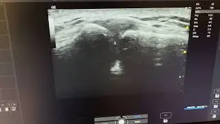 Ultrasound demonstration of the AC joint