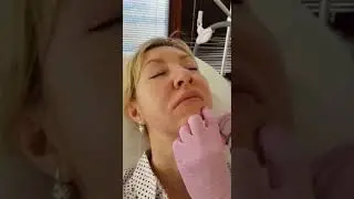 Коррекция подбородка препаратом Juvederm Volume