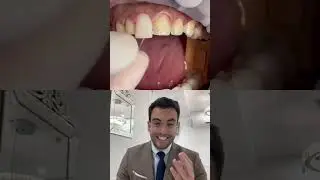 DENTISTA mostra como se coloca FACETA NOS DENTES