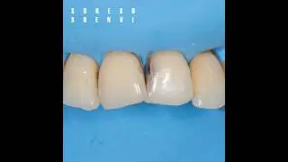 Anterior Composite 💕