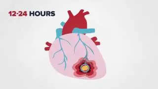 Medical Animation Heart Disease