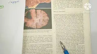 Hemostasis and Thrombosis/Pathology/Medium Robbins Part 2