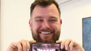 20 Prepless Veneers For Adam - Amazing Smile & Great Experience