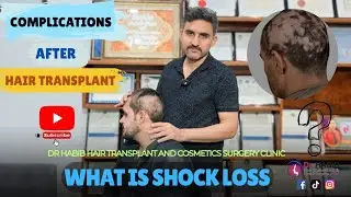 Complecations after Hair Transplant😨 What is Shockloss🤔 | Dr. Habib explain 💯