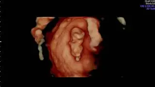 Baby Scan 11 Weeks - Early Reassurance Scan
