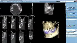 Planmeca Romexis 3D Implant Planning with open STL and crown library
