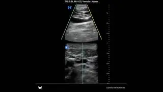 Ultrasound-guided (real-time) central venous catheter placement