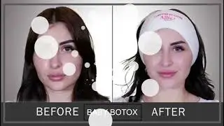 Reduce fine lines and wrinkles with Baby Botox - Harley Street Medical Centre