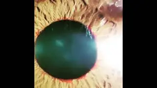 Rubeosis iridis 👁