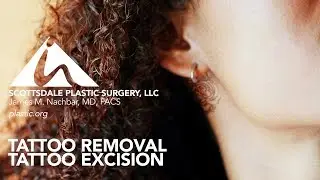Tattoo removal, tattoo excision—Scottsdale Plastic Surgery