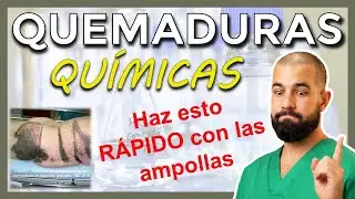QUEMADURAS QU&Iacute;MICAS. Lo m&aacute;s importante que TIENES QUE SABER