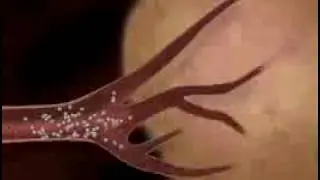 Patient - About SIR-Spheres Microspheres