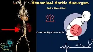 Abdominal Aortic Aneurysm AAA: Diagnosis, Risk Factors, Treatment explained : Clinical Tutorial