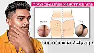 How To Remove Buttock Acne | Butt Acne Treatment | Buttock Acne Remedies 