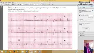 25 Examples For Long Strep ECG Prof.Dr.mahmoud Allam