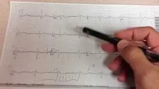 U waves on EKG