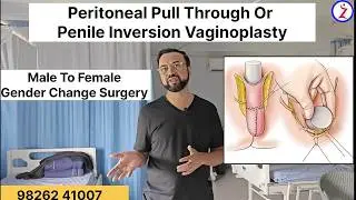 Male To Female Gender Change Surgery In India Delhi Mumbai Bangalore Kolkata Hyderabad Chandigarh