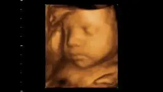 30wks 4D Ultrasound baby scan. Window to the Womb Ltd