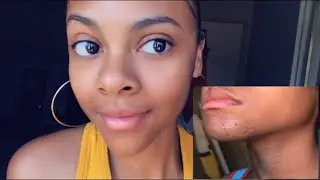 HOW TO SUCCESSFULLY REMOVE ACNE SCARS AND STRETCH MARKS