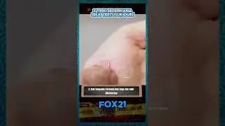 luar biasa langsung keluar #cara mengeluarkan diri di kaki atau tangan
