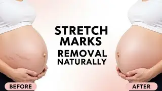 Full Body Smooth 🚫 No STRETCH Marks 100% Natural Hacks 🌸 DIY