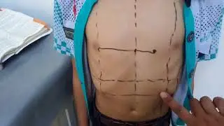 SURFACE MARKING of LIVER in easiest wayvery important