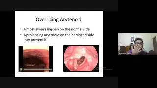 Management of Vocal Cord Palsy- Webinar by Dr Jayakumar Menon, on World Voice Day-2021