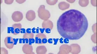 What does a reactive lymphocyte look like?