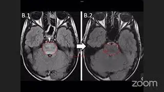 MS in Focus: Brainstem in MS Vs MOGAD