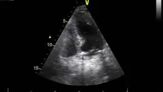 LEFT ATRIAL COMPRESSION 4 CHAMBERS
