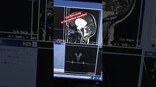 Mri csf flow Study #mri csf flow cerebral aqueduct