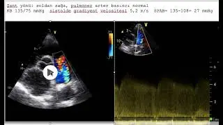 Erişkin hastalarda patent duktus arteriyozusta ekokardiyografik değerlendirme