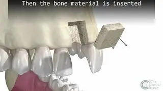 Bone Augmentation 3D animation - City Dental Clinic Bratislava