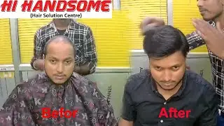 What is Hair Wig Solution | Hair Transplant in Patna |  Hi Handsome Boring Road, Patna