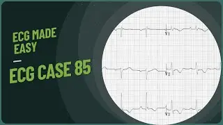 Arrhythmogenic Right Ventricular dysplasia ECG | ECG case 85