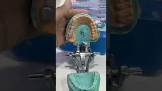 #dmls #metal🦷...