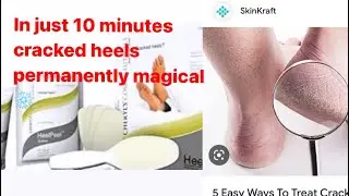 In just 10 minutes cracked heels permanently magical ❄️//Cheryl’s heels peel treatment