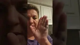 Dupytrins and Xiaflex shot 4 day update