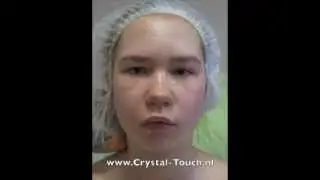 Congenital Facial Paralysis. Nadja (14) after 2 Crystal Touch treatments. Moscow.
