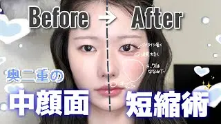 【中顔面短縮術】奥二重が中顔面短縮で気をつけるポイント徹底解説‼️