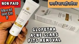Glopetra Acne Cream Review |Glopetra Acne Scar Removal Cream |Glopetra acne scars & pits removal gel