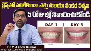 ఎత్తు,వంకర పళ్ళకి పరిష్కారం| Teeth Straightening Without Braces in Telugu | Eledent Dental Hospitals