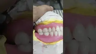 Zirconia Crown And teeth Arrangement Of Upper Lower Removable Partial Denture 😁😁😁#viralshorts