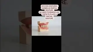 What are the single tooth replacement options?