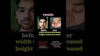 Rhinoplasty: The Complete Guide to Choosing the Best Surgeon | nose job before and after