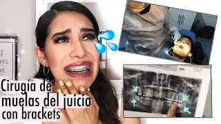 Mi experiencia con brackets 6 + CIRUGÍA DE MUELAS DEL JUICIO |Cirugía de Cordales| Carel Quezada